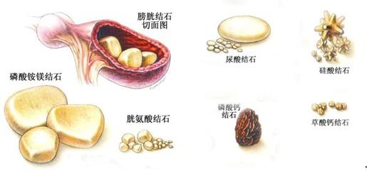 胆囊结石的概述 结石 结石-概述，结石-主要成分