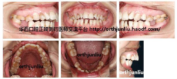 上颌窦癌的临床表现 上颌后缩 上颌后缩-治疗措施，上颌后缩-临床表现