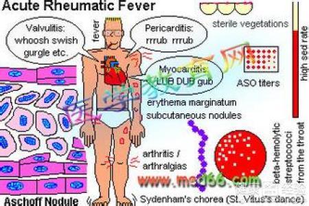 肾小球肾炎发病机制 急性肾小球肾炎 急性肾小球肾炎-流行病学，急性肾小球肾炎-发病
