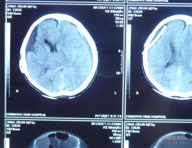 宫颈囊肿常见的体征 网膜囊肿 网膜囊肿-概述，网膜囊肿-体征