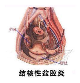 结核性盆腔炎症状 盆腔结核 盆腔结核-症状，盆腔结核-原因