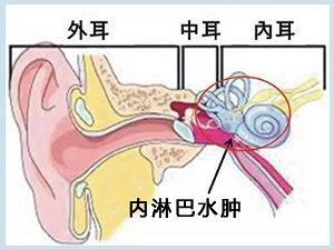 美尼尔氏综合症 美尼尔氏综合症 美尼尔氏综合症-概述，美尼尔氏综合症-病因