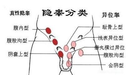 隐睾 隐睾 隐睾-概述，隐睾-介绍