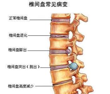 骨质增生 发病率 腰椎骨质增生 腰椎骨质增生-发病原因，腰椎骨质增生-发病机制