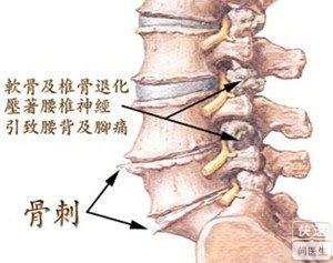 颈椎骨刺的病因 骨刺 骨刺-简介，骨刺-病因