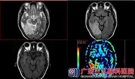 心肌梗塞发病症状 线粒体脑肌病 线粒体脑肌病-发病原因，线粒体脑肌病-症状表现