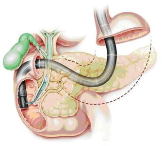 ercp适应症 ERCP ERCP-简介，ERCP-适应症