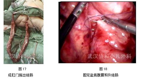 快速扩肛的方法 扩肛 扩肛-方法，扩肛-适应症