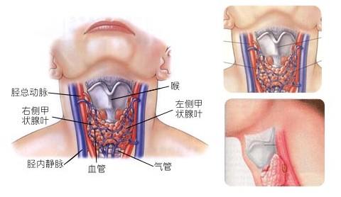 慢性甲状腺炎 慢性甲状腺炎 慢性甲状腺炎-疾病简介，慢性甲状腺炎-分类