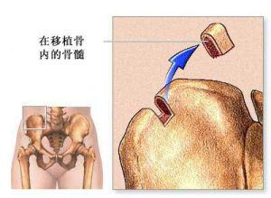 骨髓移植 骨髓 骨髓-骨髓移植，骨髓-疾病分类