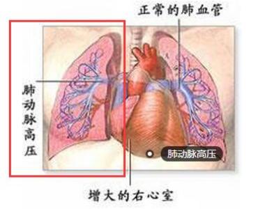 宝宝肺动脉高压怎么办 什么是肺动脉高压