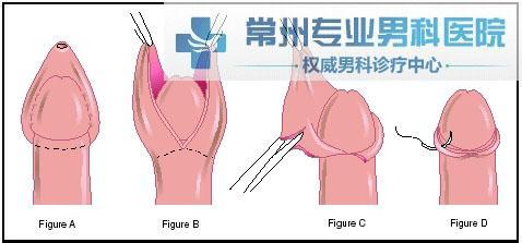 治疗包茎症状的医院 包茎 包茎-症状，包茎-治疗