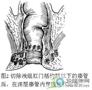 复杂肛瘘切除术 复杂肛瘘切除术 复杂肛瘘切除术-手术过程，复杂肛瘘切除术-适应
