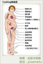 柯兴综合征症状 类柯兴综合征 类柯兴综合征-病因及症状，类柯兴综合征-疾病检查