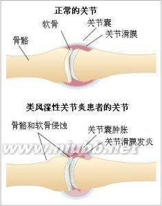 Ra 类风湿性关节炎  Ra 类风湿性关节炎 -病因，Ra 类风湿性关节