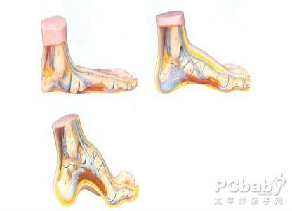 跖腱膜炎 跖腱膜炎-病因，跖腱膜炎-临床表现