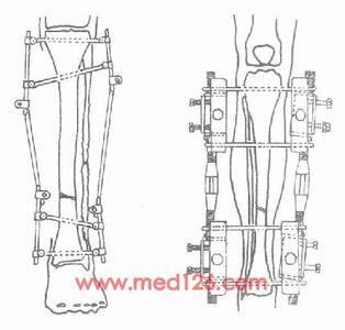 胫腓骨骨干骨折 胫腓骨骨干骨折-发病机制，胫腓骨骨干骨折-临床