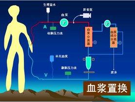 血浆置换治疗系统性红斑狼疮 血浆置换治疗系统性红斑狼疮-概述，