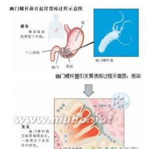 幽门螺杆菌感染 幽门螺杆菌感染-简介，幽门螺杆菌感染-病原学