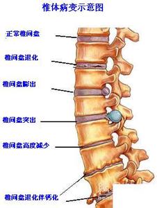 腰椎间盘突出症概述 腰椎间盘突出 腰椎间盘突出-概述，腰椎间盘突出-病名