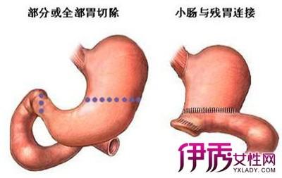 倾倒综合征的临床表现 倾倒综合征 倾倒综合征-临床表现，倾倒综合征-病因