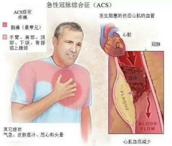 急性冠脉综合征 急性冠脉综合征-疾病简介，急性冠脉综合征-疾病