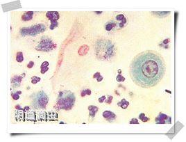 滴虫性阴道炎传染 滴虫 滴虫-具体危害，滴虫-传染方式