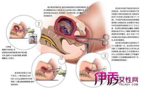 子宫全切术 子宫全切术-简介，子宫全切术-治疗原理