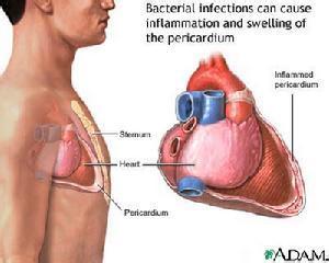 慢性缩窄性心包炎 慢性心包炎 慢性心包炎-概述，慢性心包炎-症状