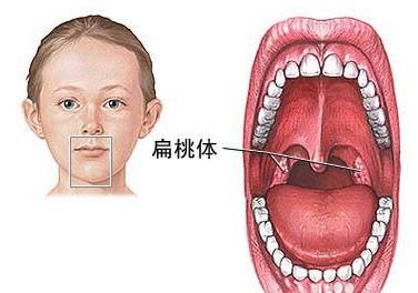 扁桃体炎 扁桃体炎-简介，扁桃体炎-临床表现