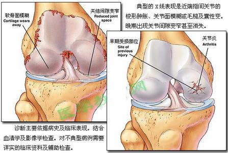 类风湿关节炎 类风湿关节炎-简介，类风湿关节炎-病因