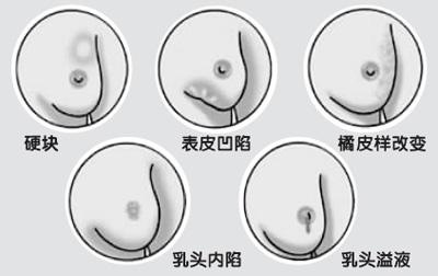 乳腺良性肿瘤 乳腺良性肿瘤-乳腺良性肿瘤症状与体征，乳腺良性肿