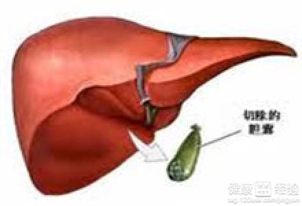 胆囊切除术后综合症 胆囊切除术后综合症-概念及症状，胆囊切除术