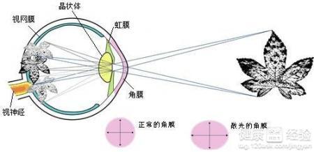 小儿远视 小儿远视-疾病概念，小儿远视-临床表现