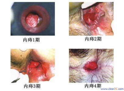 内痔疮出血 内痔疮出血-内痔出血的表现，内痔疮出血-原因