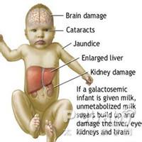 热衰竭的发病机理是 半乳糖血症 半乳糖血症-疾病概述，半乳糖血症-发病机理