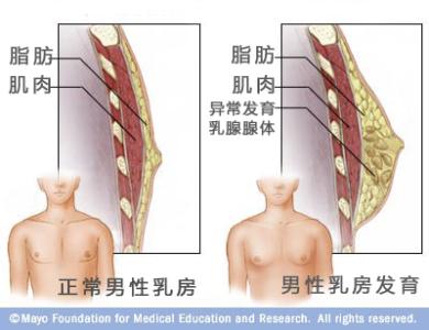 乳房发育症 乳房发育症-乳房发育症，乳房发育症-疾病分类