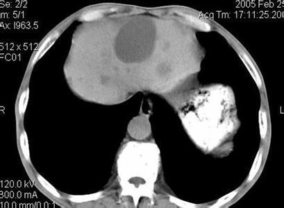 多发肝囊肿 多发肝囊肿-临床表现，多发肝囊肿-主要因素