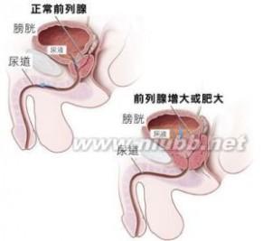 慢性前列腺炎 慢性前列腺炎-概述，慢性前列腺炎-混淆病症