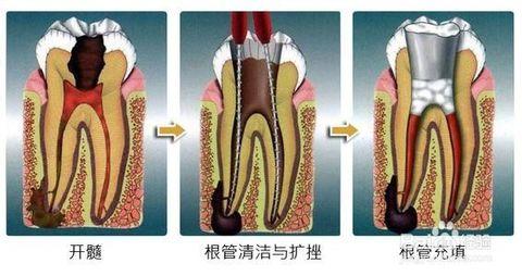 牙齿神经痛 牙齿神经痛-治疗，牙齿神经痛-保养