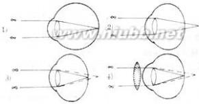 儿童远视眼怎么治疗 远视眼 远视眼-概述，远视眼-治疗措施