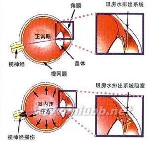 青光眼病因 青光眼 青光眼-概述，青光眼-病理病因