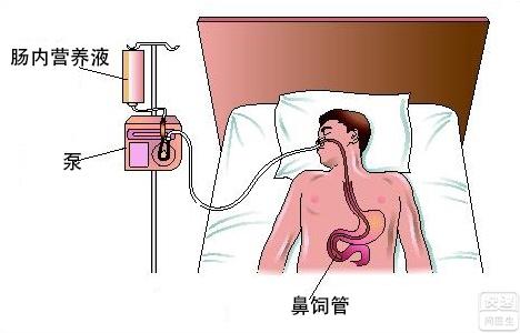 急性胰腺炎 急性胰腺炎-概述，急性胰腺炎-简介