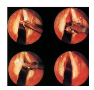 声带息肉 声带息肉-概述，声带息肉-病因