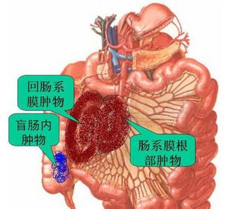 恶性淋巴瘤 恶性淋巴瘤-简介，恶性淋巴瘤-病因学