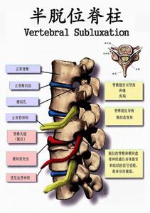 腰椎间盘突出症分型 腰椎间盘突出症 腰椎间盘突出症-病因，腰椎间盘突出症-临床分型