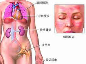 系统性红斑狼疮性肾炎 系统性红斑狼疮性肾炎-流行病学，系统性红