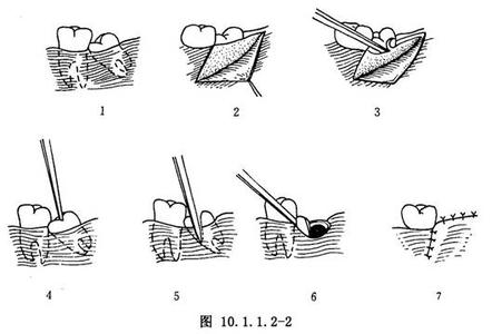 阻生牙拔除术价格 《阻生牙拔除术》