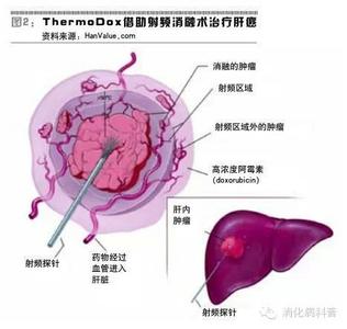 肝脏肿瘤 肝脏肿瘤-基本内容，肝脏肿瘤-症状