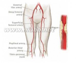 下肢动脉硬化闭塞症 下肢动脉硬化闭塞症-疾病概述，下肢动脉硬化